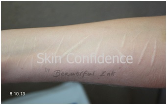 Self harm scarring on arm before